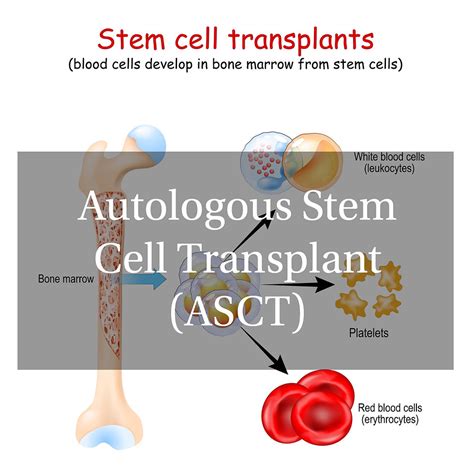 Patient education: Hematopoietic cell transplantation (bone .